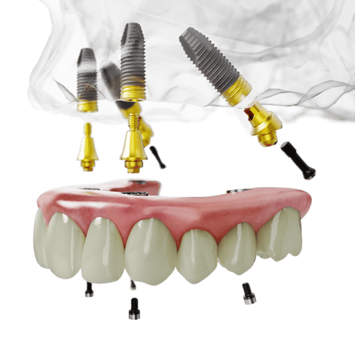 All-on-4 Bobel Biocare