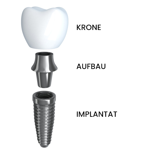 Implantat Teile