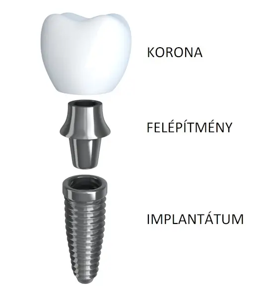 implantátum, felépítmény, korona